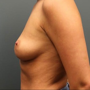 Breast-Augmentation-22 | Before Breast Augmentation 2