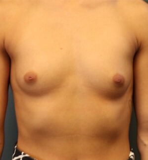 Breast-Augmentation-Patient-18 | Before Breast Augmentation 1