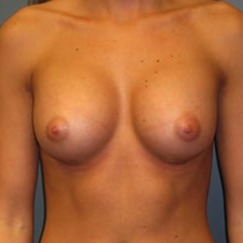 Breast-Augmentation-Patient-02 | After Breast Augmentation 1