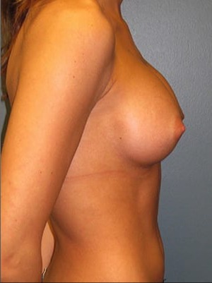 Breast-Augmentation-Patient-02 | After Breast Augmentation 2