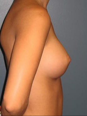 Breast-Augmentation-Patient-03 | After Breast Augmentation 2