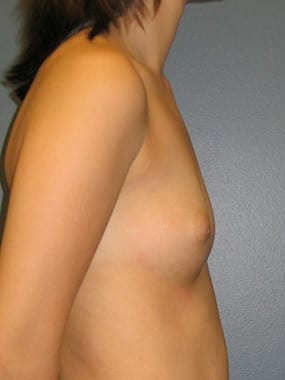 Breast-Augmentation-Patient-03 | Before Breast Augmentation 3