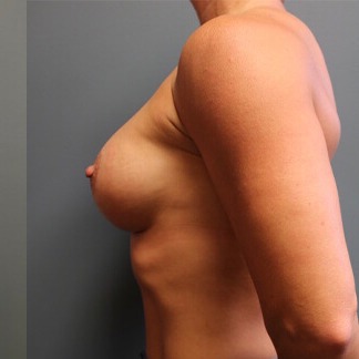 Breast-Lift-With-Augmentation-Patient-03 | After Breast Augmentation and Mastopexy 3