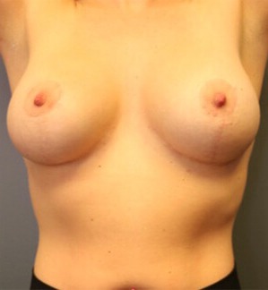 Breast-Lift-With-Augmentation-Patient-06 | After Breast Augmentation and Mastopexy 2