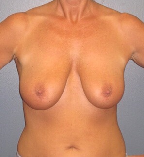 Breast-Augmentation-and-Mastopexy-using-Galaform-Patient-01 | Before Breast Augmentation and Mastopexy using Galaform 1