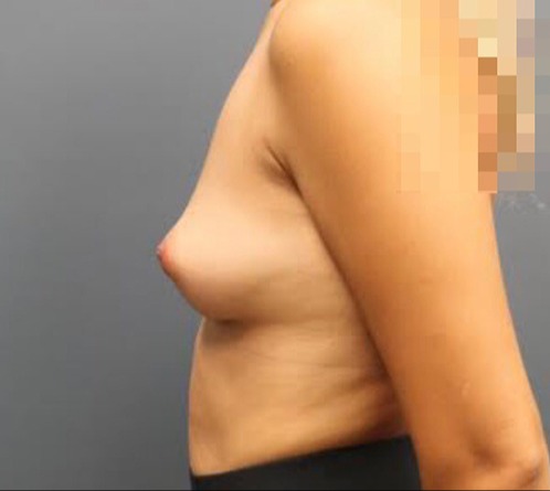 Breast-Augmentation-Patient-20 | Before Breast Augmentation 3