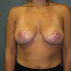 Mastopexy-Patient-01 | After Mastopexy 1