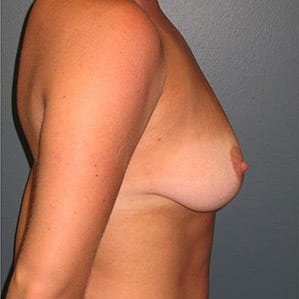 Mastopexy-Patient-01 | Before Mastopexy 2
