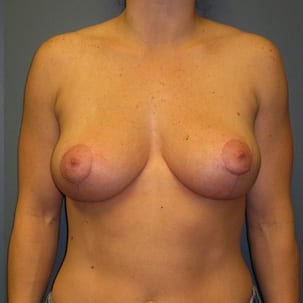 Mastopexy-Patient-03 | After Mastopexy 1