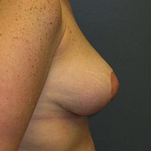 Mastopexy-Patient-02 | After Mastopexy 2