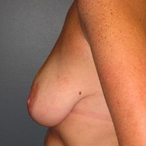 Mastopexy-Patient-02 | Before Mastopexy 3