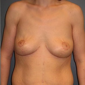 Mastopexy-Patient-04 | After Mastopexy 1