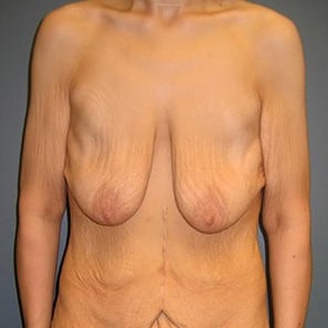 Mastopexy-Patient-04 | Before Mastopexy 1