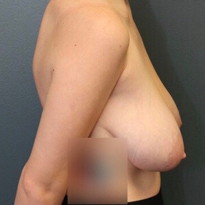 Breast-Reduction-Patient-03 | Before Breast Reduction 2