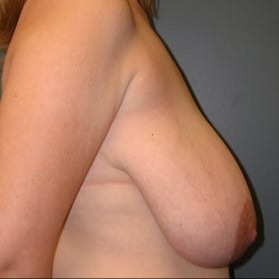 Breast-Reduction-Patient-01 | Before Breast Reduction 3