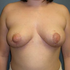Breast-Reduction-Patient-02 | After Breast Reduction 1