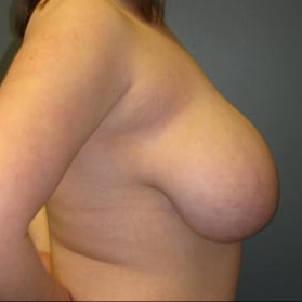 Breast-Reduction-Patient-02 | Before Breast Reduction 3