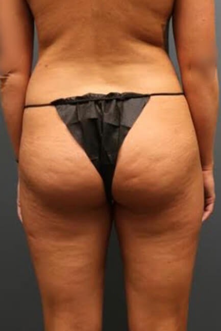 Butt-Augmentation-Patient-01 | Before Butt Augmentation 1