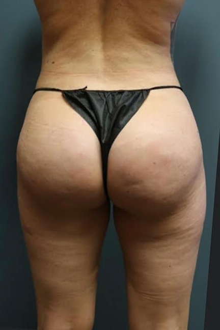 Butt-Augmentation-Patient-01 | After Butt Augmentation 1