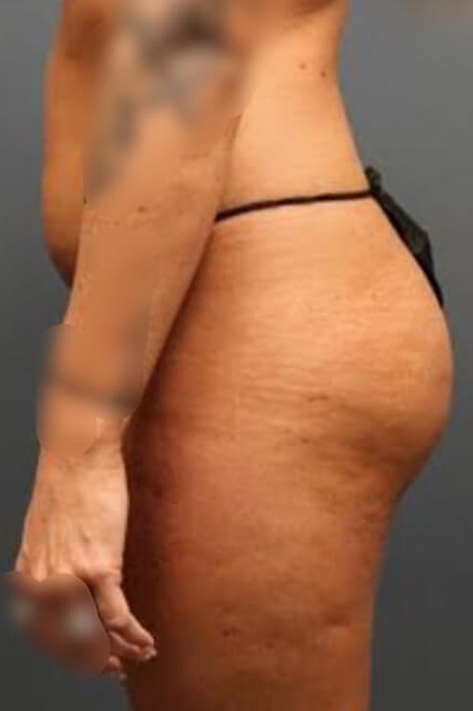 Butt-Augmentation-Patient-01 | Before Butt Augmentation 3
