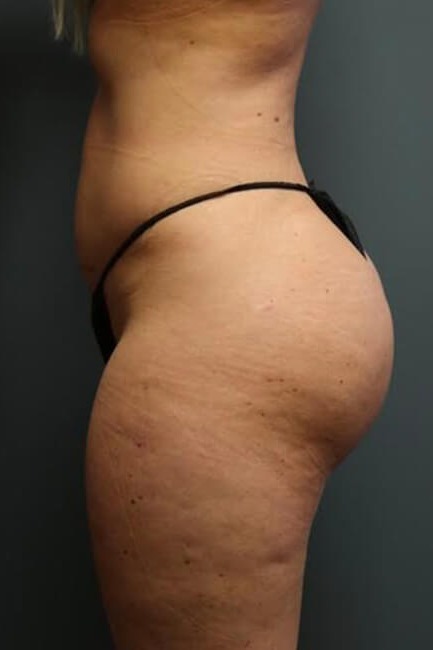 Butt-Augmentation-Patient-01 | After Butt Augmentation 3