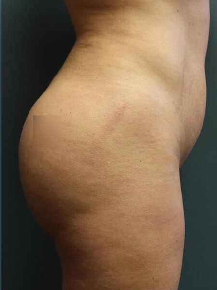 Butt-Augmentation-Patient-02 | After Butt Augmentation 2
