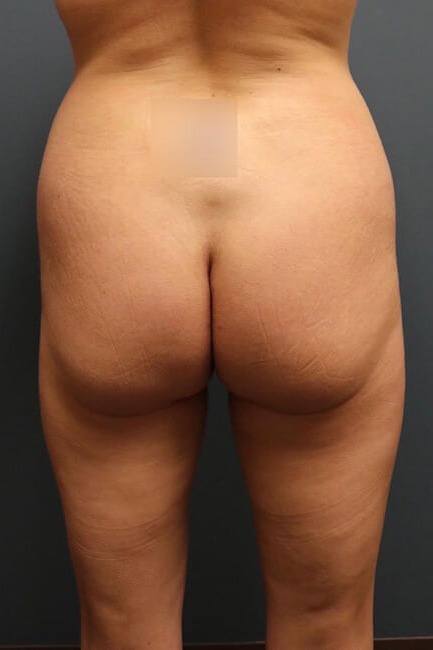 Butt-Augmentation-Patient-02 | Before Butt Augmentation 1