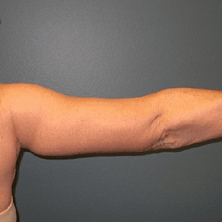Arm-Lift-Patient-02 | After Arm Lift 3