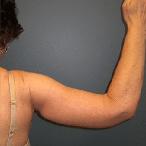 Arm-Lift-Patient-02 | After Arm Lift 4