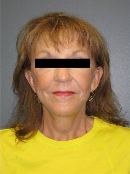 Facelift-Neck-Lift-Patient-02 | After Facelift / Neck Lift 1