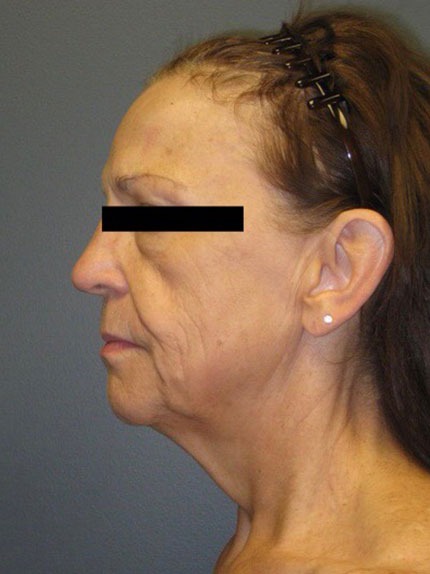 Facelift-Neck-Lift-Patient-02 | Before Facelift / Neck Lift 2