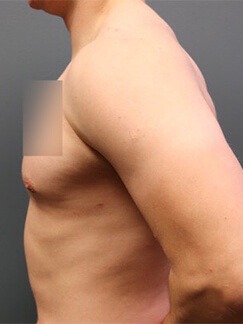 Gynecomastia-Patient-02 | After Gynecomastia 1