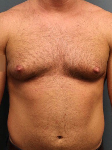 Gynecomastia-Patient-03 | Before Gynecomastia 1