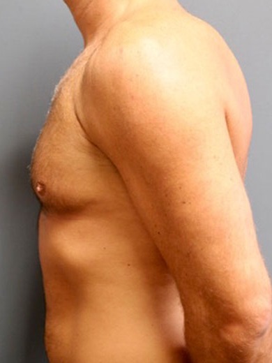 Gynecomastia-Patient-03 | After Gynecomastia 2