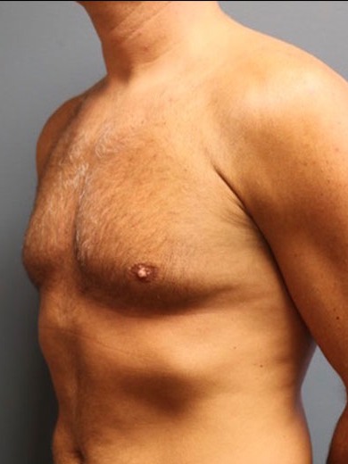 Gynecomastia-Patient-03 | After Gynecomastia 3