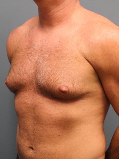 Gynecomastia-Patient-03 | Before Gynecomastia 3