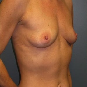 Breast-Augmentation-Patient-07 | Before Breast Augmentation 2
