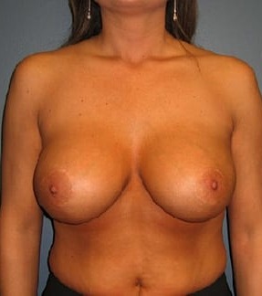 Breast-Lift-With-Augmentation-Patient-02 | After Breast Augmentation and Mastopexy 1