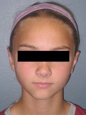 Otoplasty-Patient-02 | After Otoplasty 1