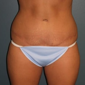 Abdominoplasty-Patient-03 | After Abdominoplasty 1