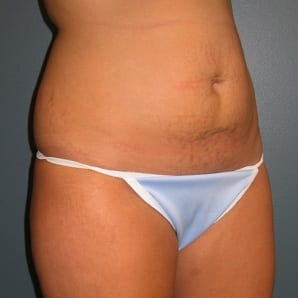 Abdominoplasty-Patient-03 | Before Abdominoplasty 2