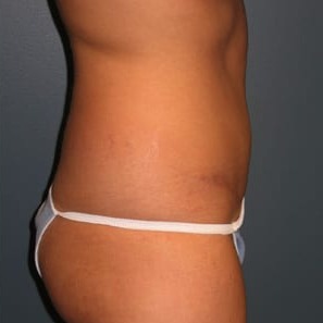 Abdominoplasty-Patient-03 | After Abdominoplasty 3