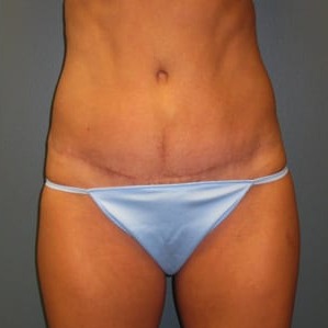 Abdominoplasty-Patient-04 | After Abdominoplasty 1